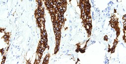 Identificación de una firma genética para optimizar la predicción de la respuesta al tratamiento en el cáncer de mama