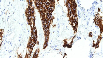 Identificación de una firma genética para optimizar la predicción de la respuesta al tratamiento en el cáncer de mama